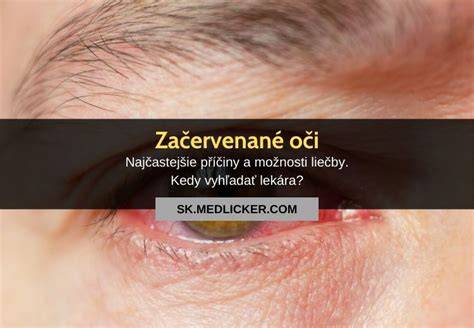 Dieta šikmé alebo mandľové oči príznaky a príčiny